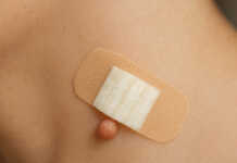 Κοντινή φωτογραφία που δείχνει ένα κομμάτι φλούδας μπανάνας τοποθετημένο πάνω σε ένα θήλωμα στο δέρμα, στερεωμένο με επίδεσμο, ως φυσική θεραπεία