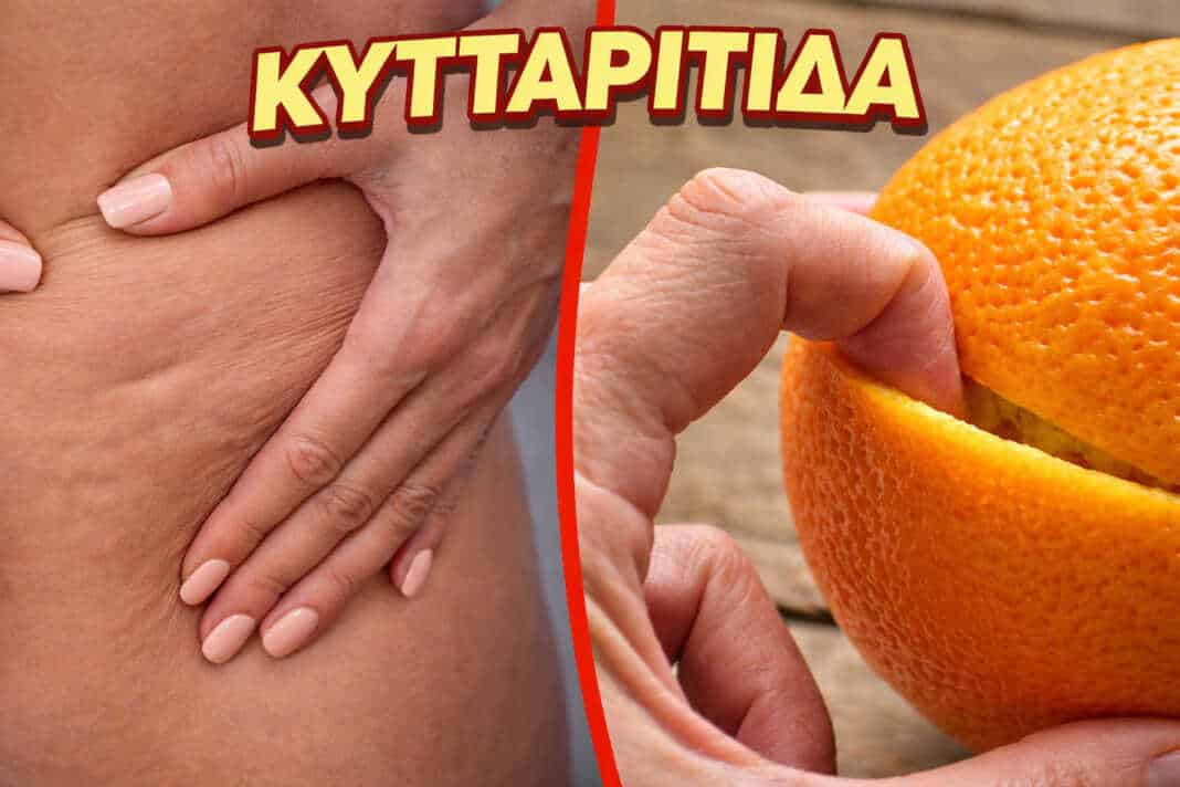 Ζάχαρη, αλάτι και αλκοόλ — τροφές που προκαλούν κυτταρίτιδα και κατακράτηση νερού