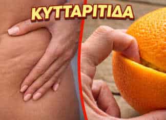 Ζάχαρη, αλάτι και αλκοόλ — τροφές που προκαλούν κυτταρίτιδα και κατακράτηση νερού