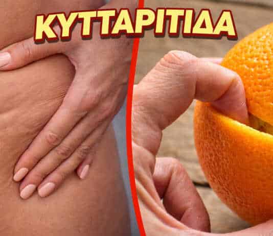 Ζάχαρη, αλάτι και αλκοόλ — τροφές που προκαλούν κυτταρίτιδα και κατακράτηση νερού